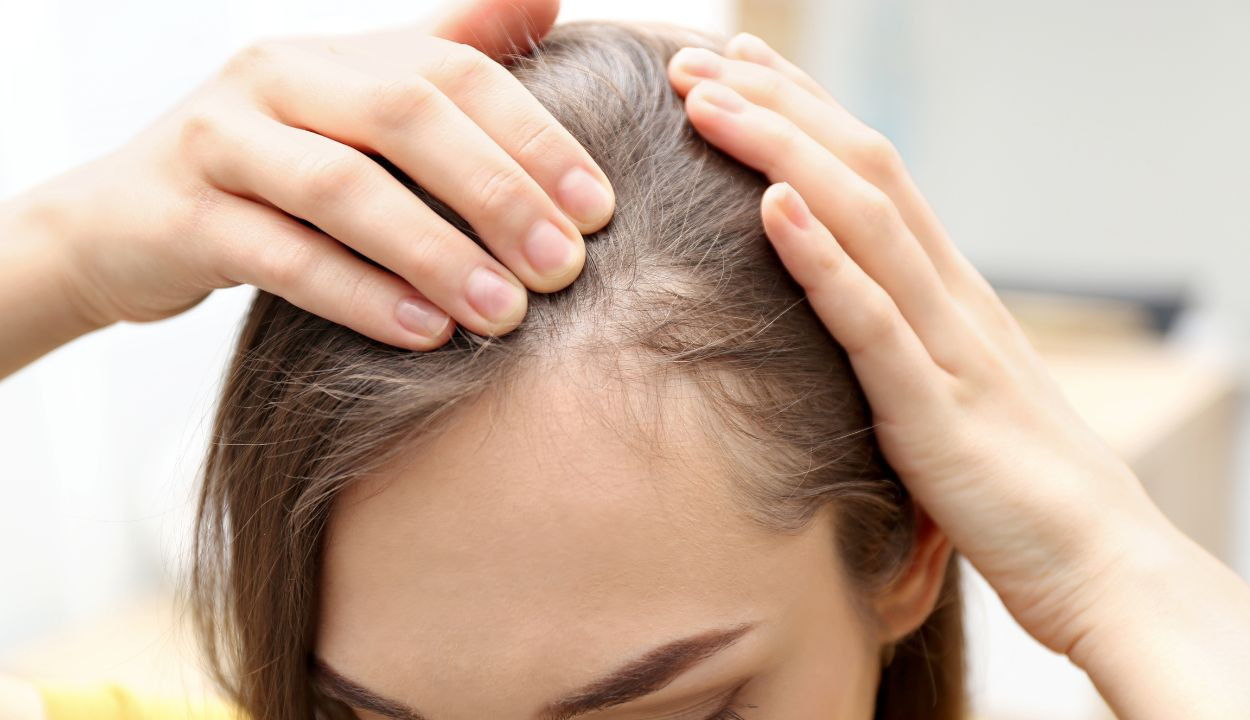 Kerontokan Rambut pada Wanita, Jenis, Gejala, Penyebab, Penanganan dan Pengobatannya